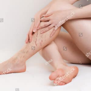 Post-op recovery posture – Female patient seated with crossed legs and hands resting