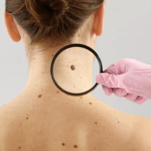 Skin examination – Back of woman with visible mole under magnifying glass