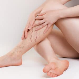 Spider veins on legs – Female patient showing visible venous condition for vascular treatment