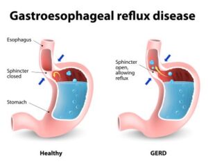 GERD vs healthy digestion – Side-by-side medical diagram comparing acid reflux and normal digestion