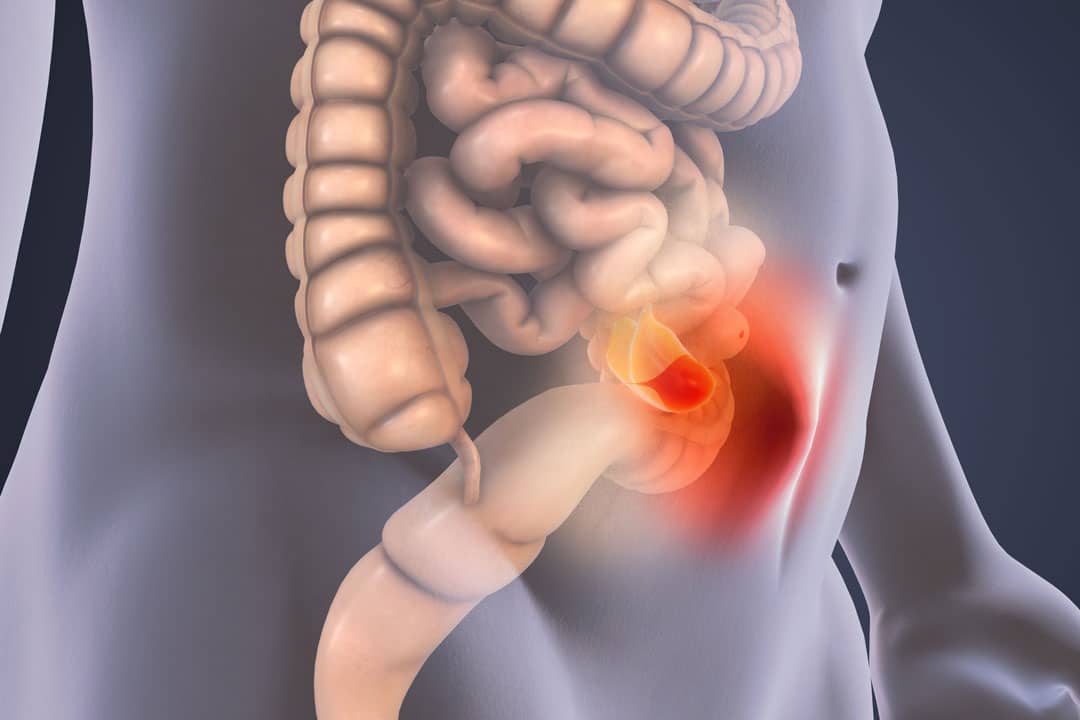 What Does a Hernia Feel Like Illustration