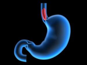 Esophagus Surgery Boulder