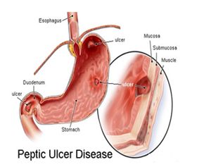 Stomach Ulcer Boulder